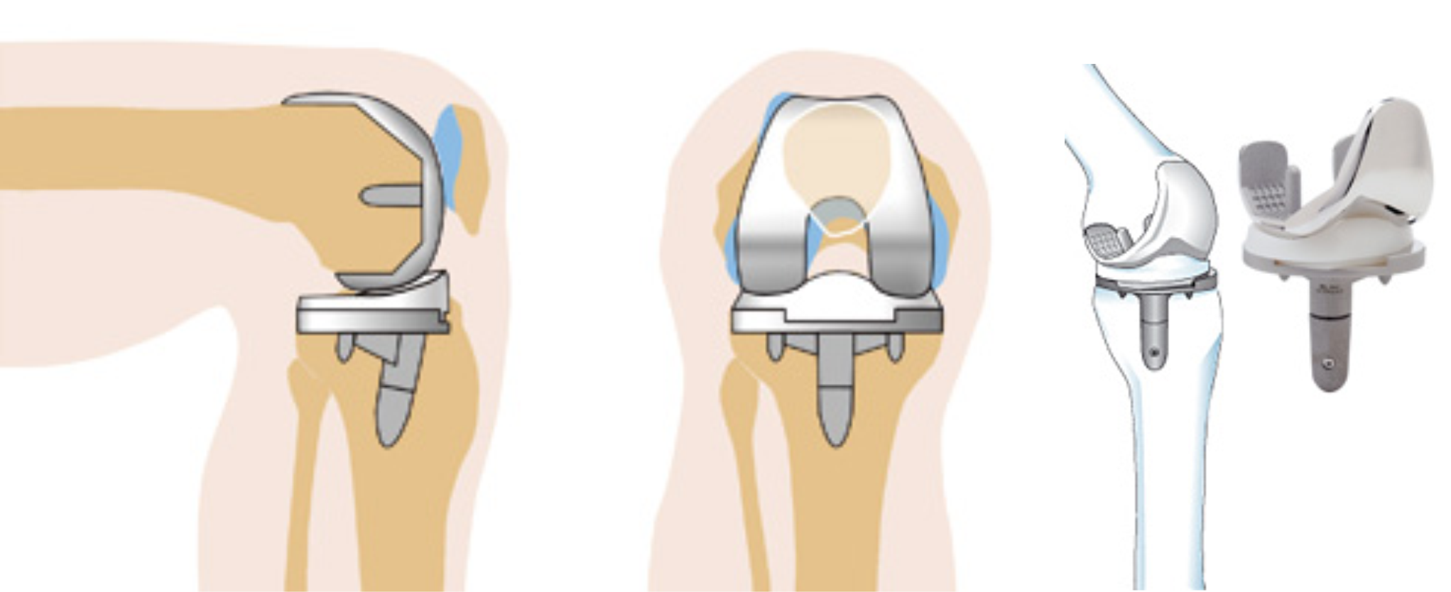 Барнаул суставы операция. Эндопротез коленного сустава. Тотальное эндопротезирование коленного сустава DEPUY. Эндопротезирование коленного сустава этапы операции. Артроз коленного сустава эндопротез.